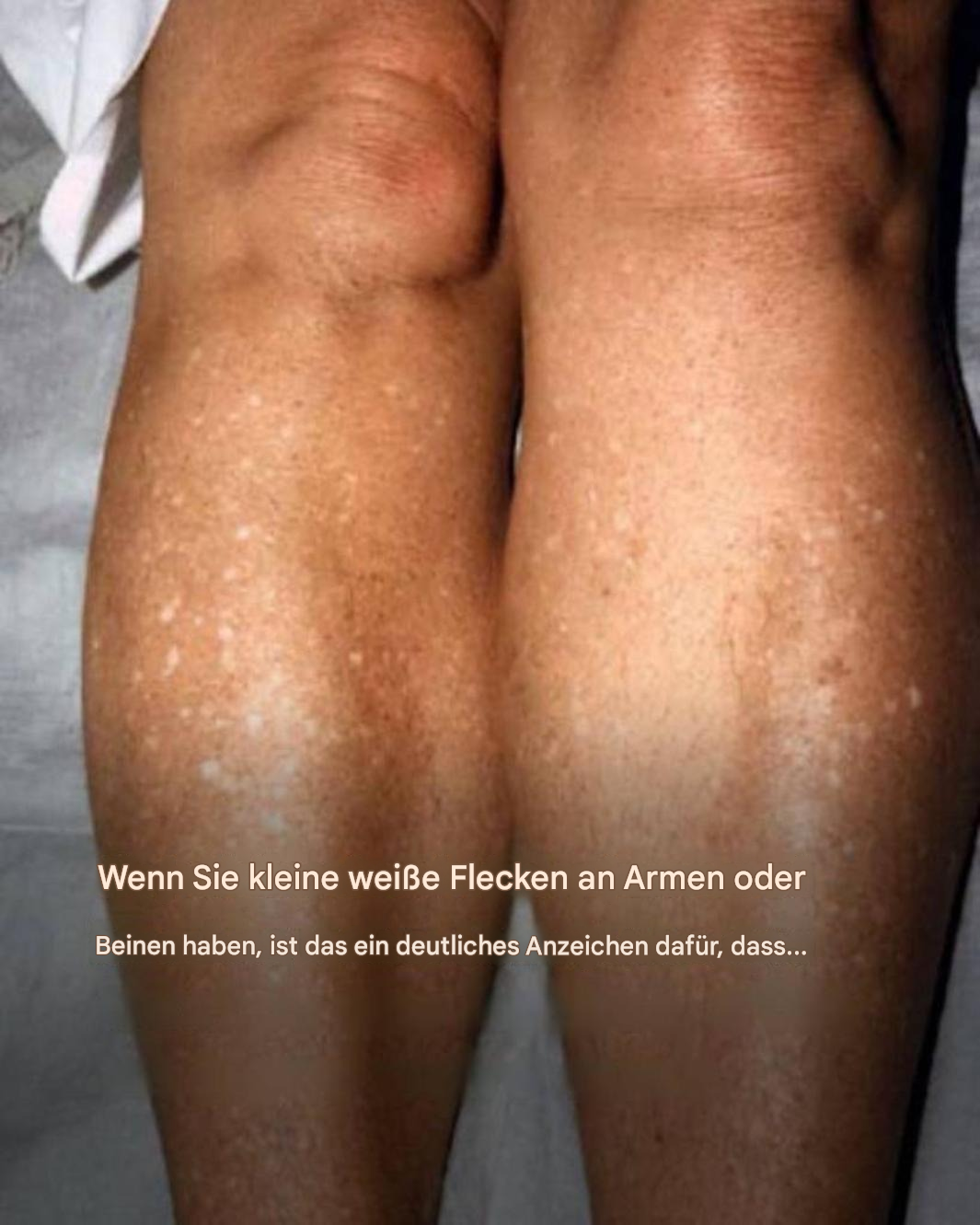 Why do I get white spots on my skin in the summer and how can I treat them? A dermatologist gives the answer.