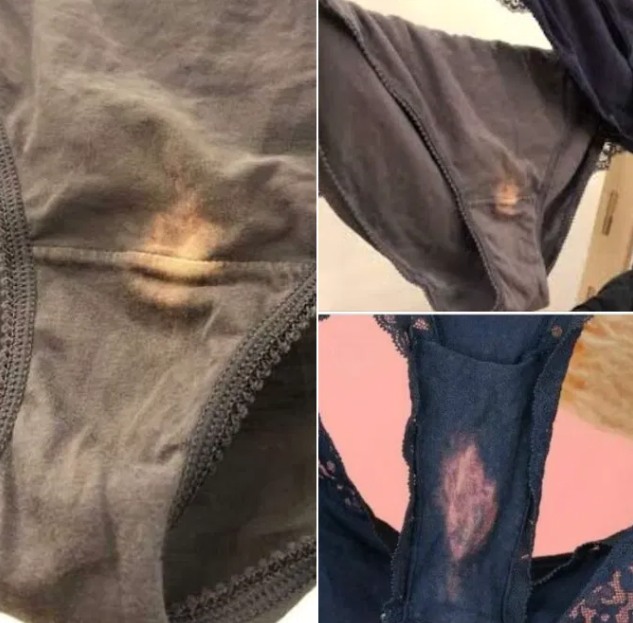 If you find a “bleach” patch on your underwear, here’s what it means