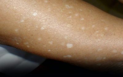 Have You Noticed Small White Spots on Your Arms or Legs? Here’s What They Are