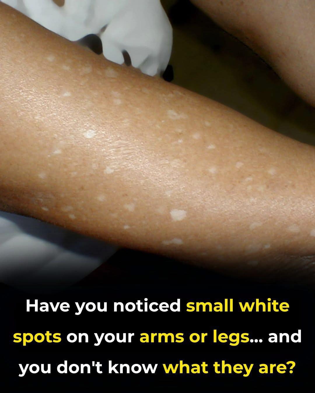 Have You Noticed Small White Spots on Your Arms or Legs? Here’s What They Are