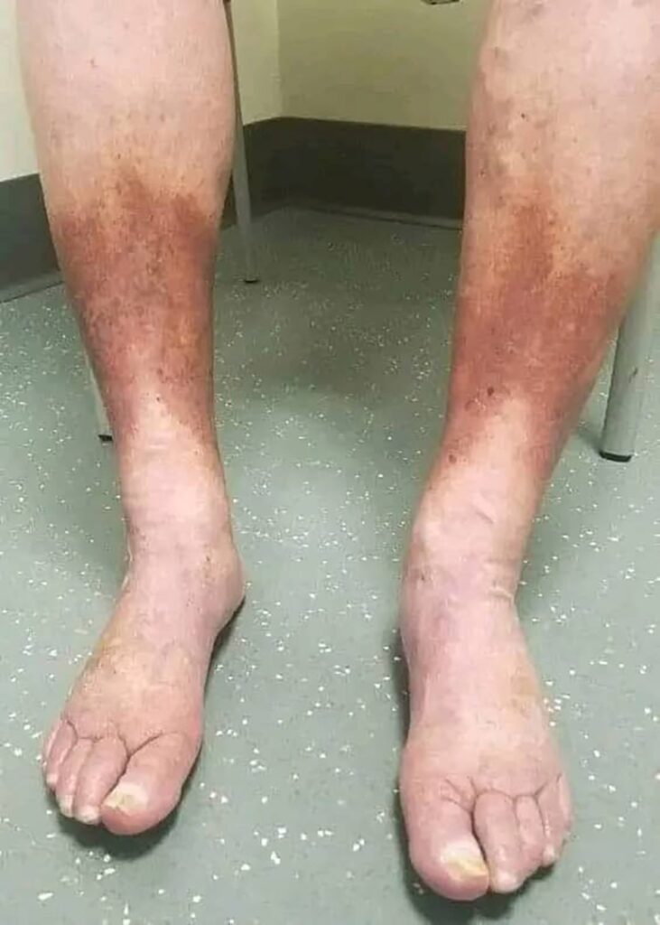 What Are the Early Symptoms of Lou Gehrig's Disease?