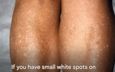 Why do I get white spots on my skin in the summer and how can I treat them? A dermatologist answers. 1