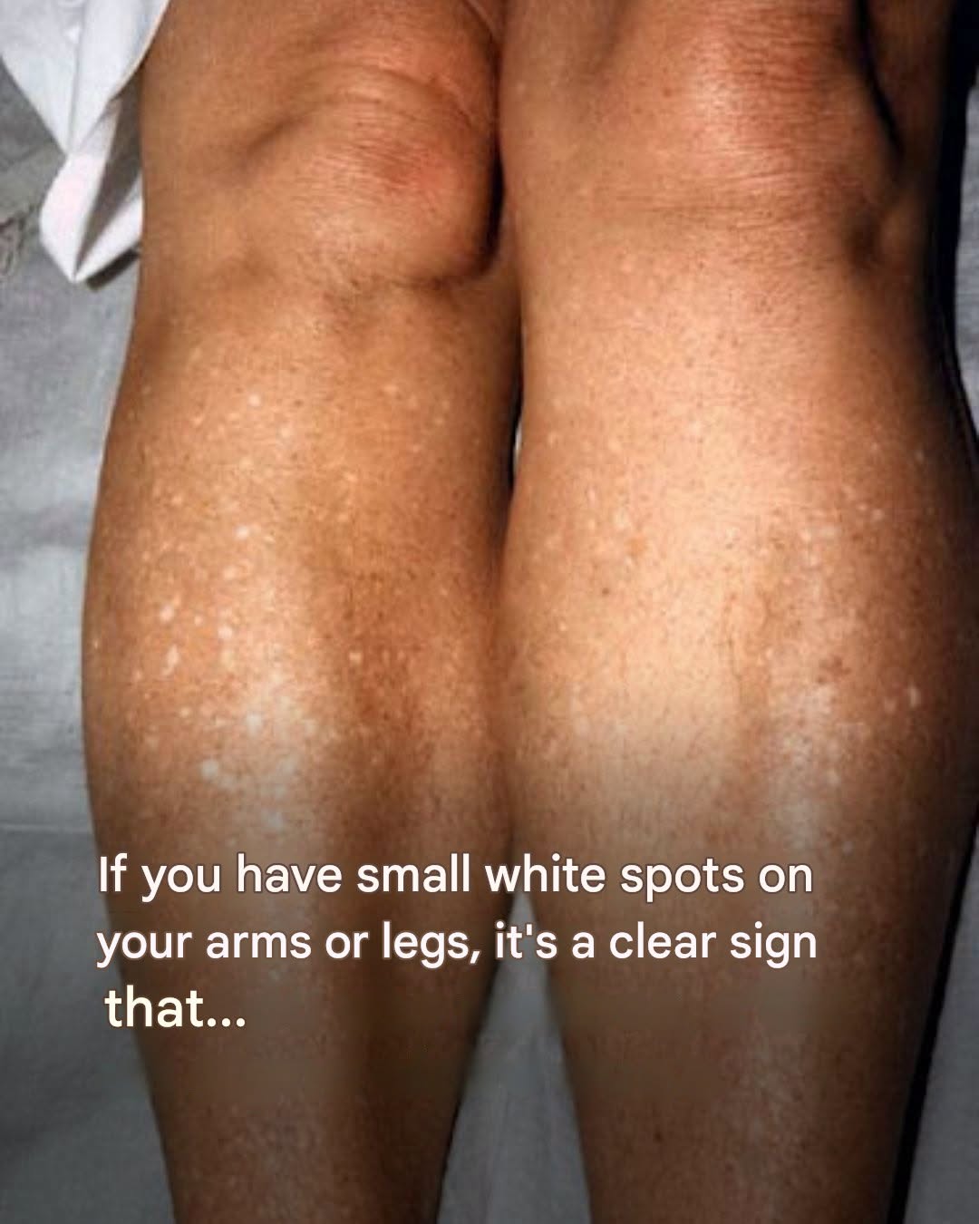 Why do I get white spots on my skin in the summer and how can I treat them? A dermatologist answers. 1