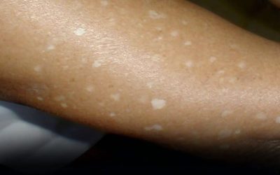 Have You Noticed Small White Spots on Your Arms or Legs? Here’s What They Are
